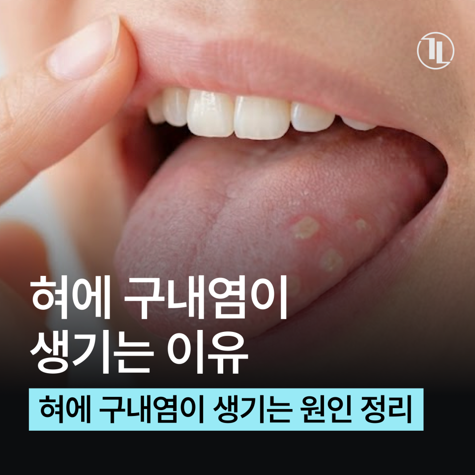 혀에 자꾸 구내염이 생긴다면? 원인부터 치료 관리법까지 / 강남레옹치과 관련 이미지 1