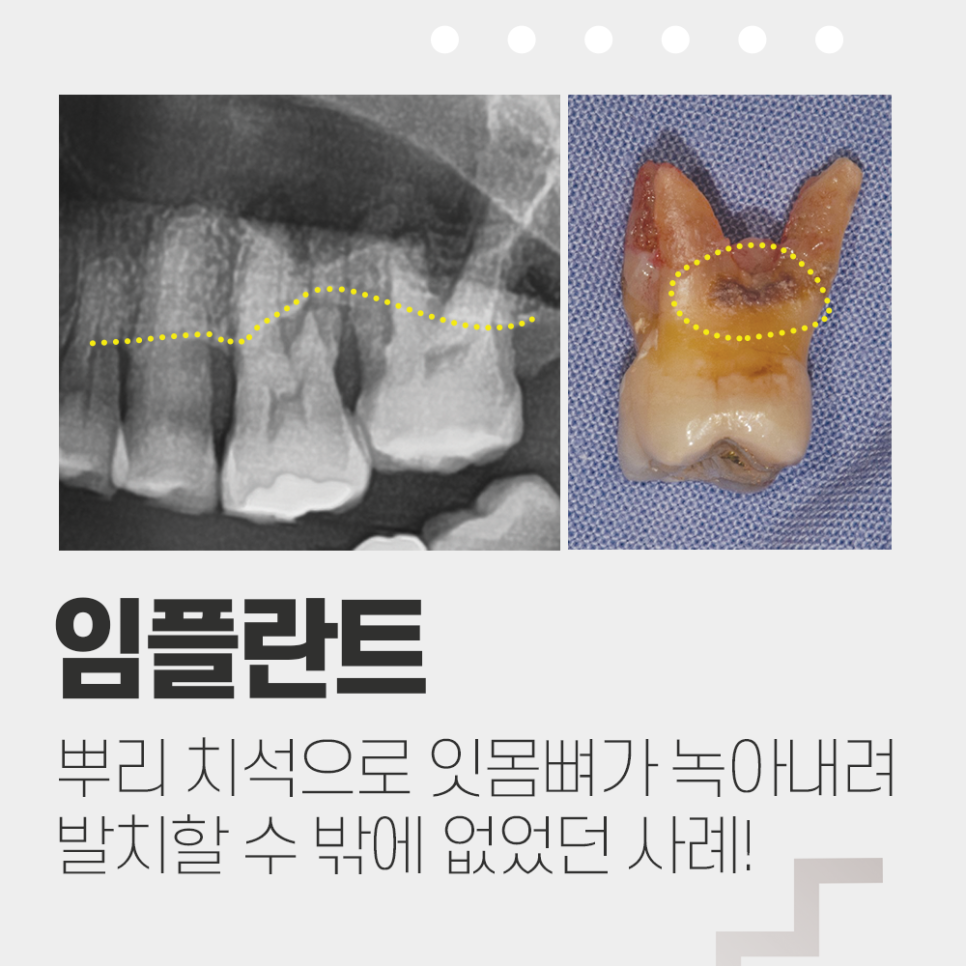 치주질환이 심하여 발치를 한 뒤 임플란트수술 관련 이미지 1