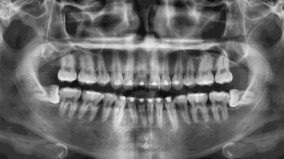 강남레옹치과 사랑니 발치 전문! 아프기 전에 미리 뽑아주세요! 관련 이미지 6