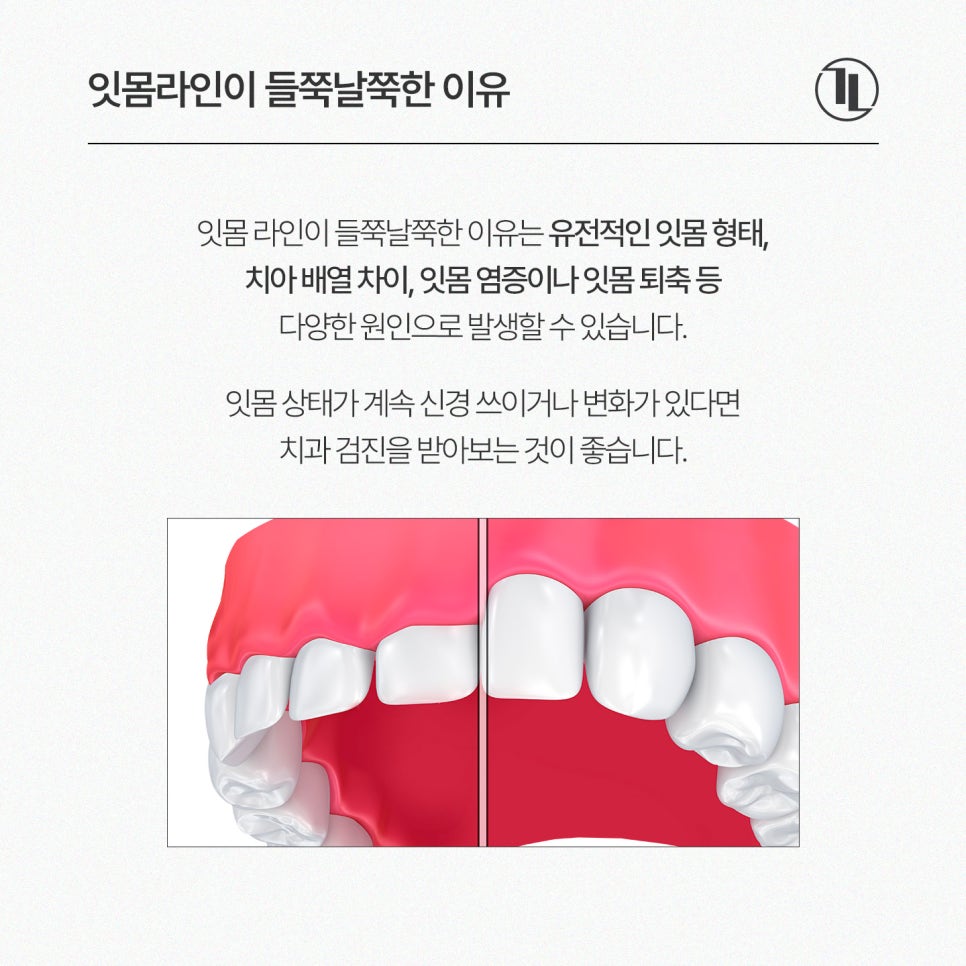 앞니 잇몸 라인이 들쭉날쭉하다면? 잇몸성형 치료 과정부터 회복 기간&middot;주의 사항까지 / 강남레옹치과 관련 이미지 2