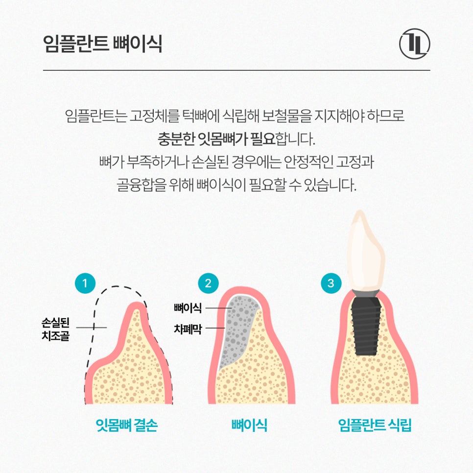 A Complete Guide to National Health Insurance Coverage for Implants / Out-of-Pocket Costs, Number Covered, Treatment Period, Bone Grafting, and FAQs / Gangnam Leon Dental Clinic image 4