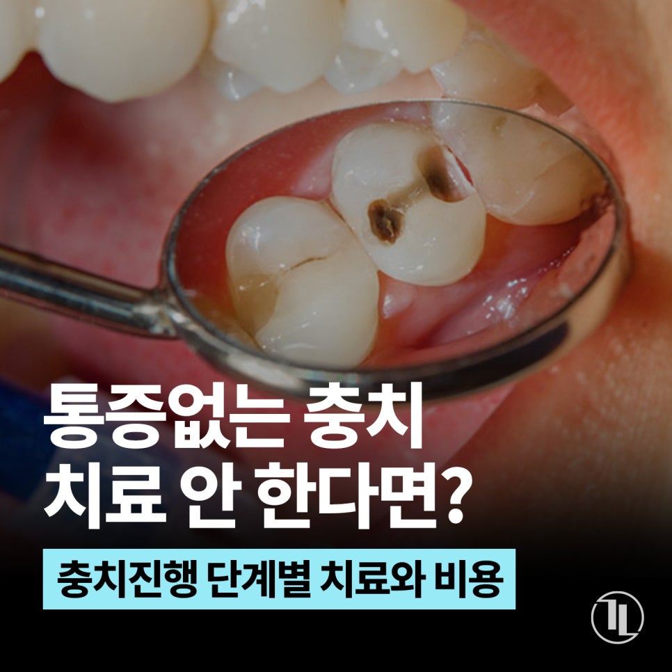 통증없는 충치, 치료하지 않아도 될까? / 충치치료 종류와 비용 / 강남레옹치과 관련 이미지 1