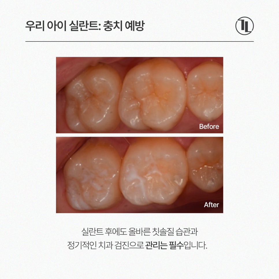 어린이 실란트, 언제 해야 할까? 시기와 보험 혜택까지 쉽게 설명 / 강남레옹치과 관련 이미지 7