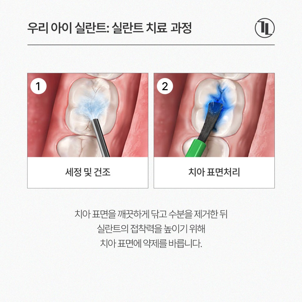 어린이 실란트, 언제 해야 할까? 시기와 보험 혜택까지 쉽게 설명 / 강남레옹치과 관련 이미지 5