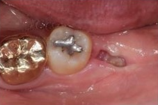 사랑니 발치 후 회복과정 한 눈에 보기🔍 / 강남역 사랑니 강남레옹치과 관련 이미지 10