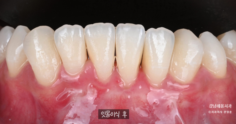 Gum Recession: Can It Expose the Tooth Roots? Before and After Gum Grafting! / Gangnam Leon Dental Clinic image 6