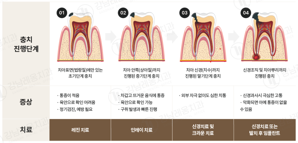 통증없는 충치, 치료하지 않아도 될까? / 충치치료 종류와 비용 / 강남레옹치과 관련 이미지 2