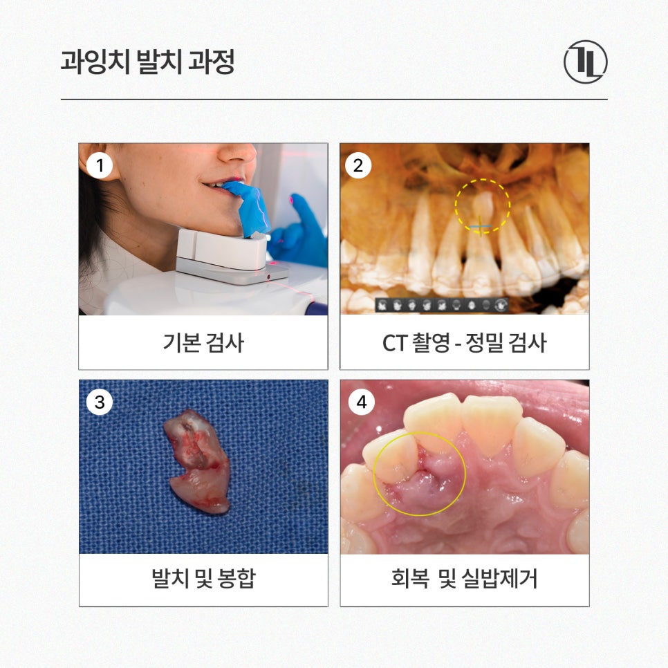 과잉치 원인부터 발치까지 / 과잉치 발치 과정 / 강남레옹치과 관련 이미지 4