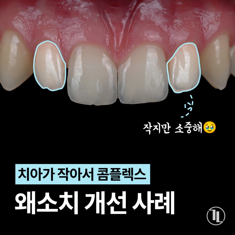 치아가 작아서 콤플렉스? 왜소치 개선 전후 사례👐 / 강남레옹치과 관련 이미지 1