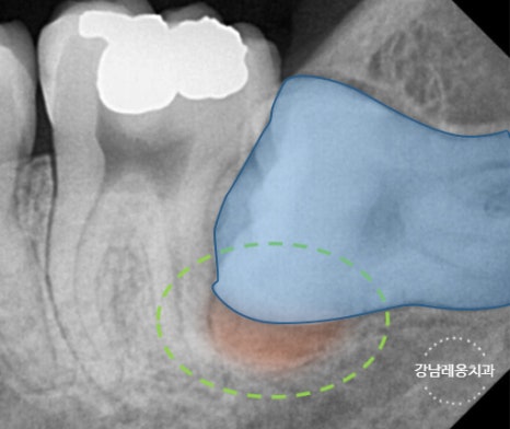 사랑니 발치, 왜 어떤 경우에 대학병원을 권유할까? / 강남레옹치과 관련 이미지 7