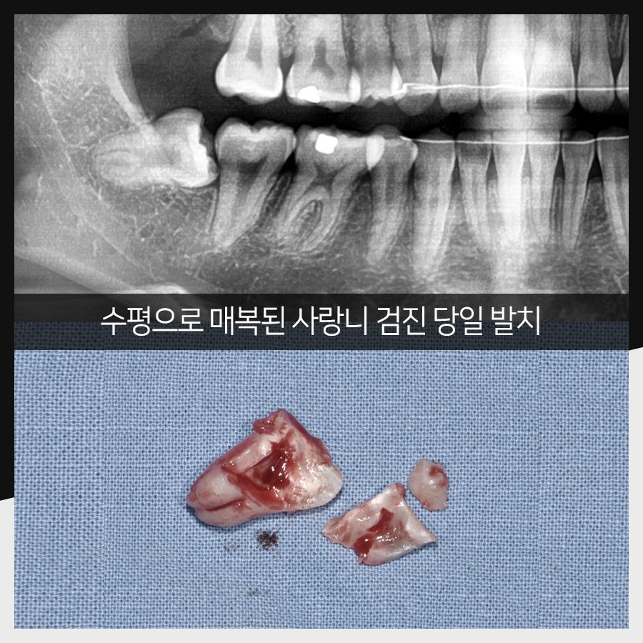 강남레옹치과 사랑니 발치, 결과가 증명해주는 실력! 관련 이미지 26