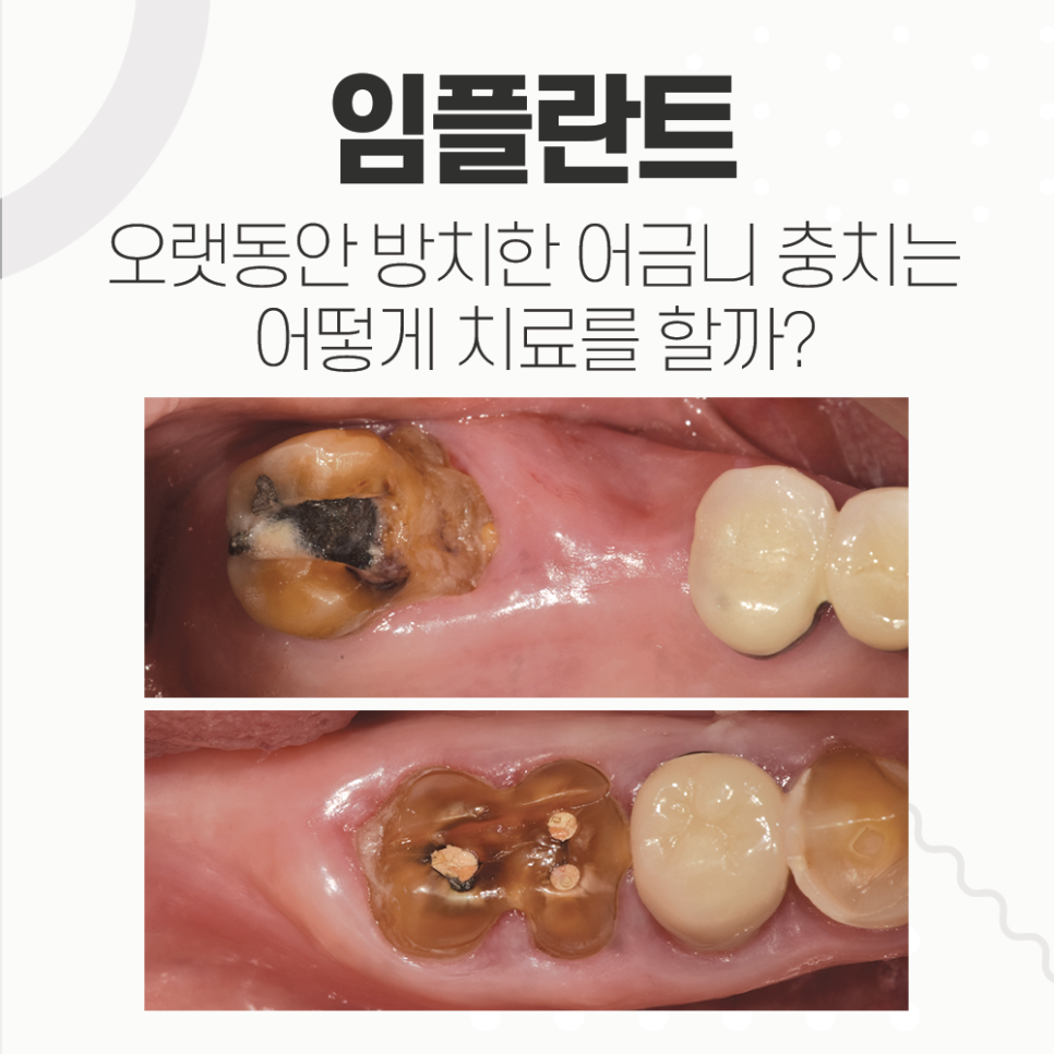 어금니 충치 미루면 임플란트 수술 할 때 뼈이식도 관련 이미지 1