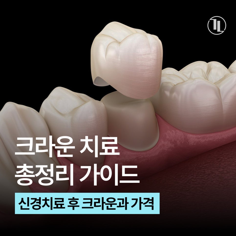 크라운 치료 가이드 / 충치&middot;신경치료 후 크라운과 가격&보험 / 강남레옹치과 관련 이미지 1