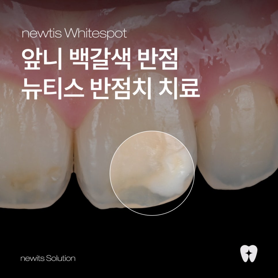 앞니 하얀점, 뉴티스 반점치 제거로 당일 개선 / 강남레옹치과 관련 이미지 1