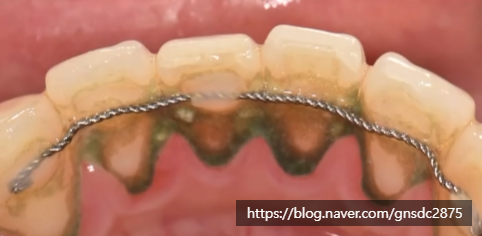 겨울철 구강관리, 스케일링 한 번으로 바뀌는 잇몸 상태❄️ / 강남레옹치과 관련 이미지 8