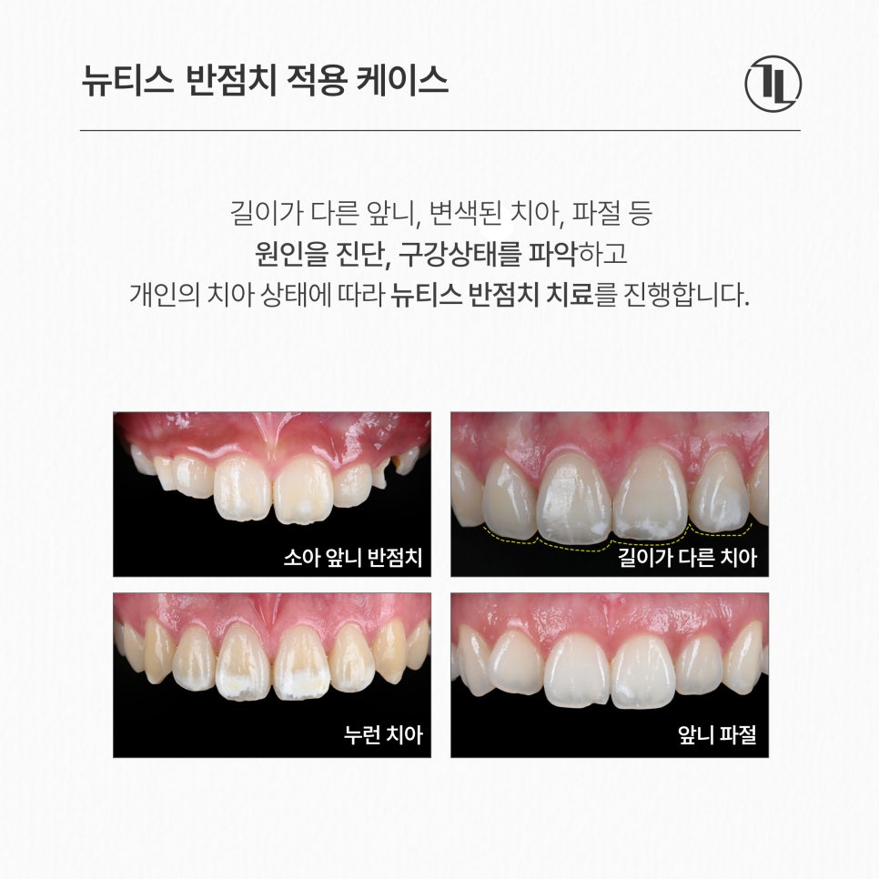 앞니 하얀 얼룩, 반점치 치료 케이스 / 아이콘레진 치료 방법 / 강남레옹치과 관련 이미지 4