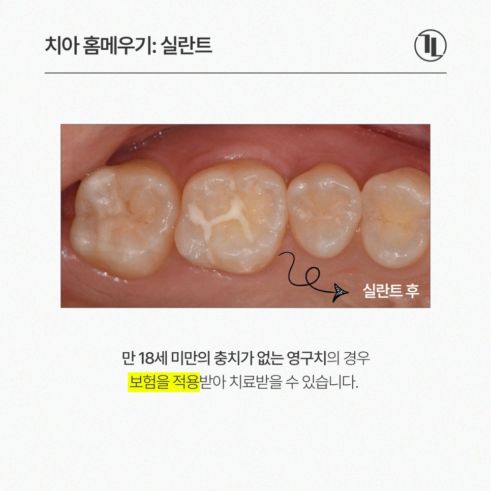 아이 충치 예방 치아 홈메우기 총정리! 실란트 시기&middot;비용(보험적용)&middot;효과 완벽 가이드 / 강남레옹치과 관련 이미지 4