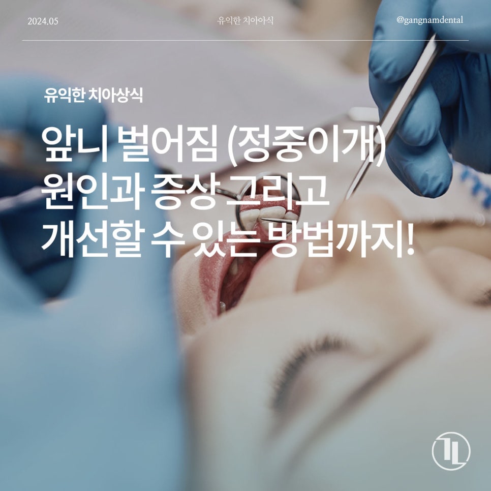 치아 벌어짐 / 앞니 사이 간격 넓어짐 / 정중이개 원인의 증상 그리고 개선할 수 있는 방법에 대해 관련 이미지 1