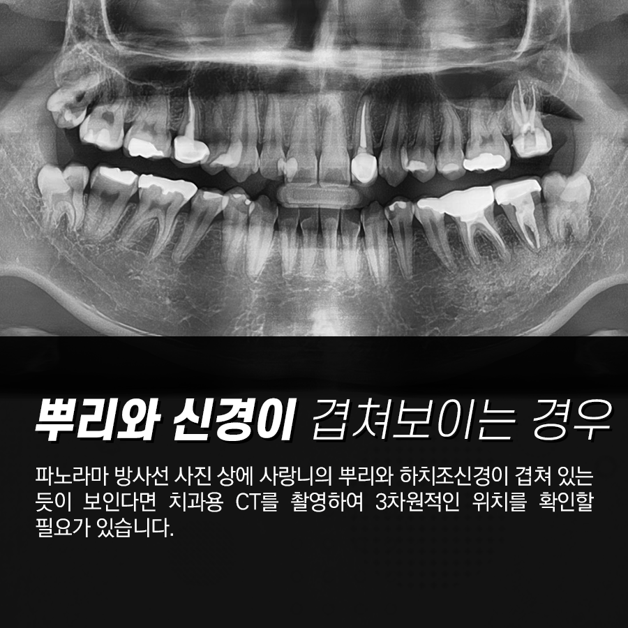 강남레옹치과 사랑니 발치 CT촬영 이유 그리고 비용 안내 관련 이미지 2