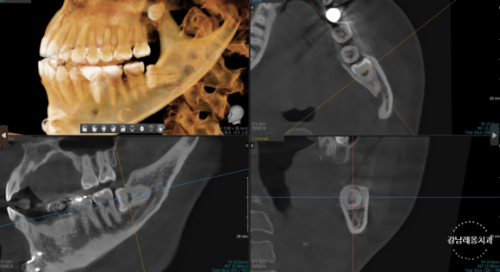 강남레옹치과 사랑니 발치 Vlog📽️ | 사랑니 발치 과정 대공개! 관련 이미지 9