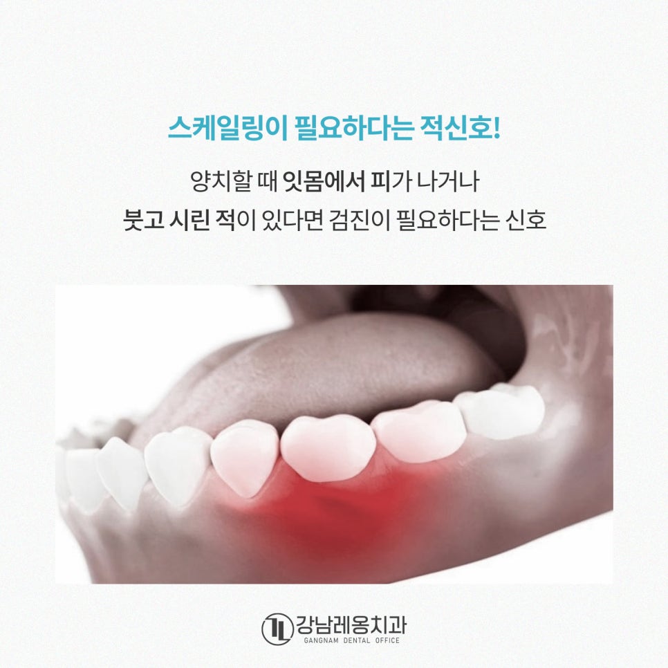 겨울철 구강관리, 스케일링 한 번으로 바뀌는 잇몸 상태❄️ / 강남레옹치과 관련 이미지 3