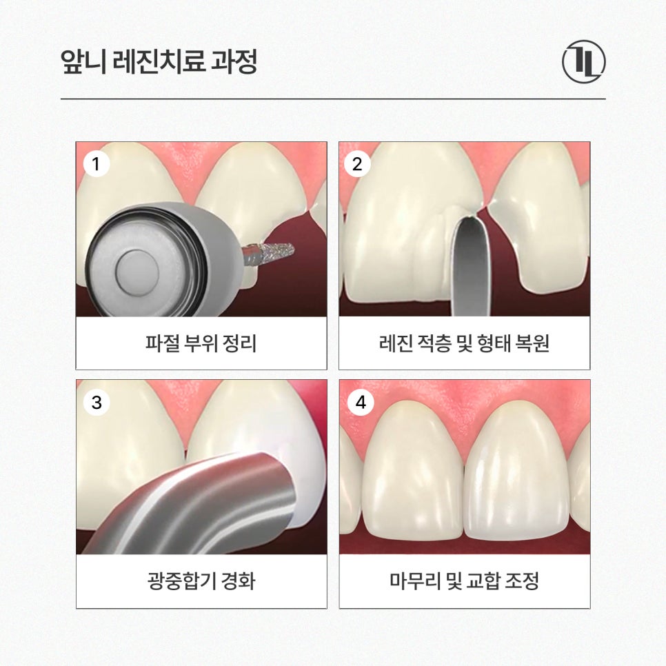 앞니가 깨졌다면?! 4가지 치료방법 비교! / 레진을 선택한 이유 / 강남레옹치과 관련 이미지 5