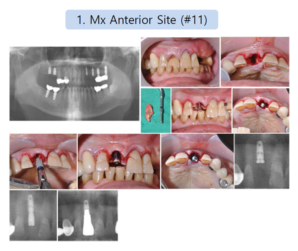 발치 즉시 임플란트 식립에 관한 논문에 참여 관련 이미지 3