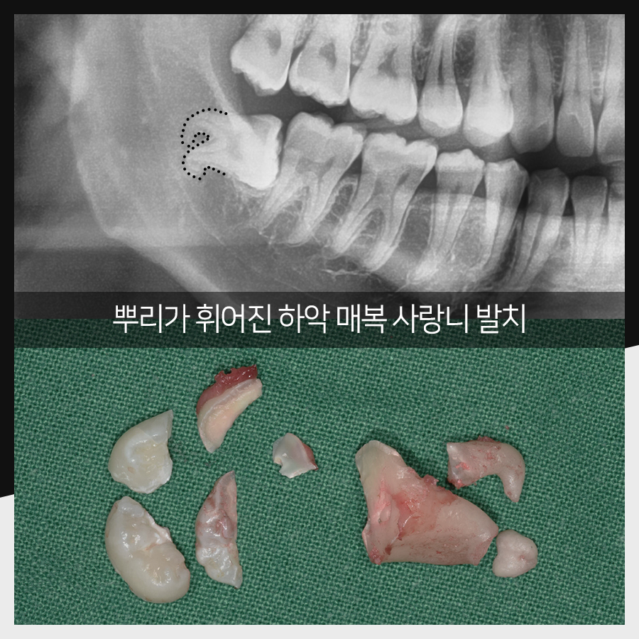 강남레옹치과 사랑니 발치, 결과가 증명해주는 실력! 관련 이미지 23
