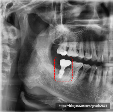 사랑니 통증, 약 먹으며 방치하면 안되는 이유! 실제 방치 사례🔍 / 강남레옹치과 관련 이미지 7