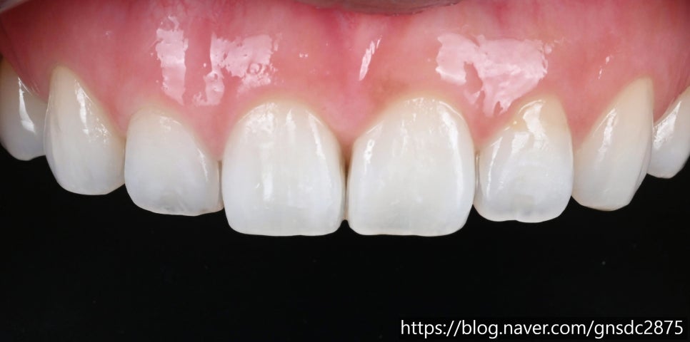 뉴티스 반점치 치료✨ 최다 임상적용, 반점치 제거 아이콘레진 / 강남레옹치과 관련 이미지 6