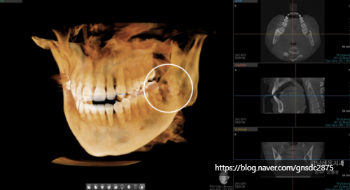 뿌리를 남긴 사랑니 발치? / 강남역 사랑니발치 강남레옹치과 관련 이미지 5