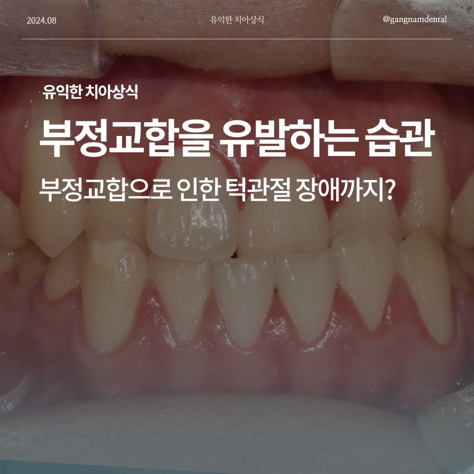 부정교합을 유발하는 생활습관이 있다고? / 부정교합으로 인한 턱관절 장애까지? / 치아교정치과 / 강남레옹치과 관련 이미지 1