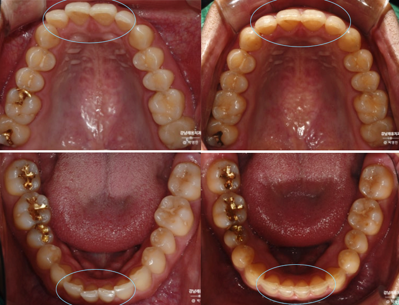 치과의사가 직접 경험한 인비절라인 특징과 진행과정👨&zwj;⚕️ / 강남레옹치과 관련 이미지 7
