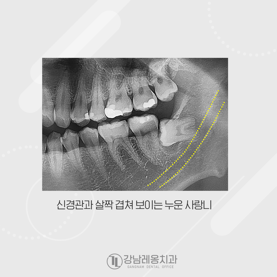 누운 사랑니 발치, 신경관과 겹쳐있는데 강남레옹치과에서 가능한가요? 관련 이미지 2