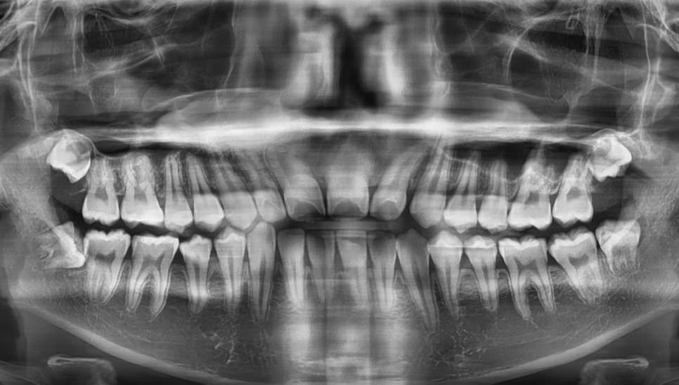 강남레옹치과 사랑니 발치 전문! 아프기 전에 미리 뽑아주세요! 관련 이미지 2