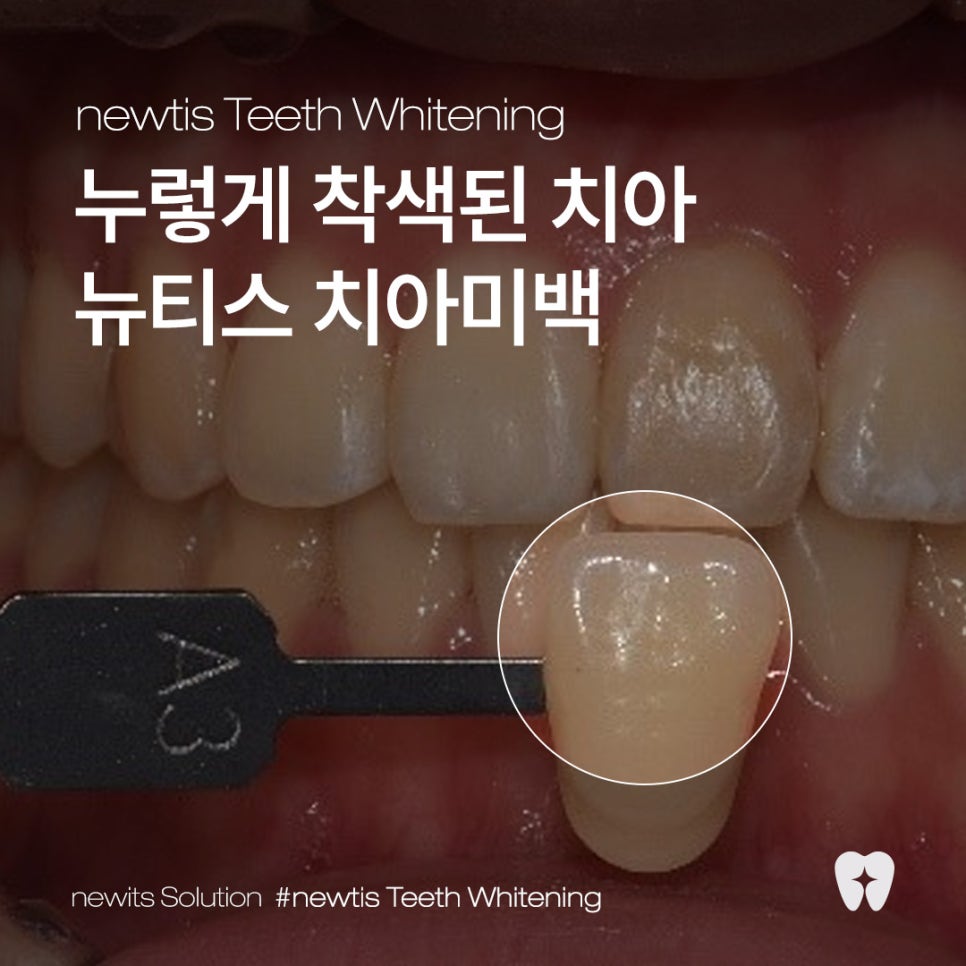 강남레옹치과 뉴티스 치아미백 Vlog📽️ | 치아미백 효과, 유지기간, 부작용 총정리! 관련 이미지 1