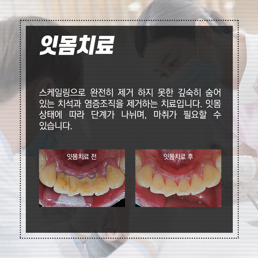 강남역 보험 스케일링, 잇몸치료!! 구강건강 지키는 꿀팁 관련 이미지 4