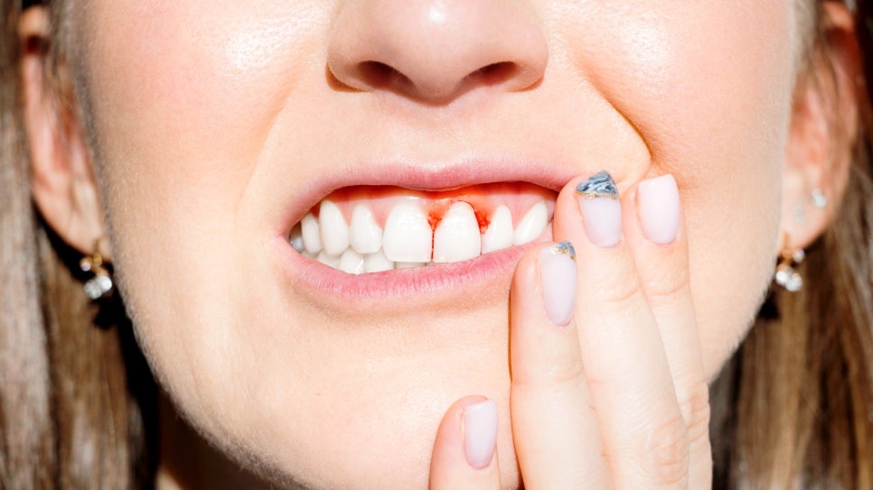 잇몸과 치아 사이 공간 &lsquo;블랙트라이앵글&rsquo;을 무시하면 안되는 이유! / 생기는 원인과 해결 방법 / 강남레옹치과 관련 이미지 7