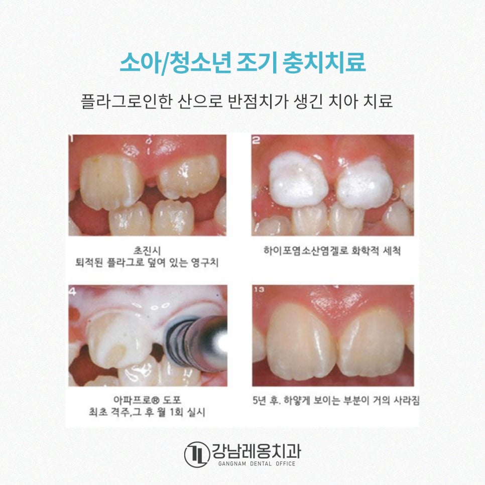 충치예방부터 시린이 완화까지! 아파프로 치아영양제의 5가지 효과✨ / 강남레옹치과 관련 이미지 12