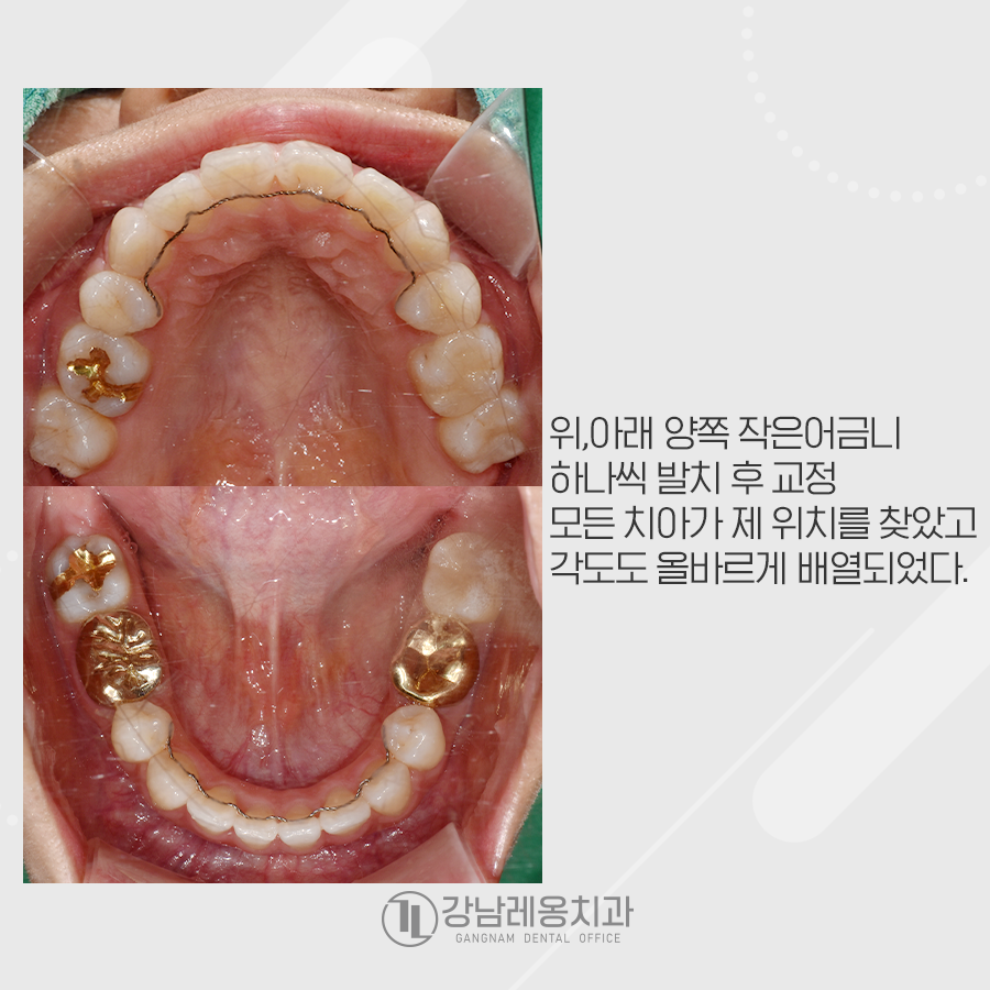 치아총생 덧니를 가지런하게 교정~! 관련 이미지 4