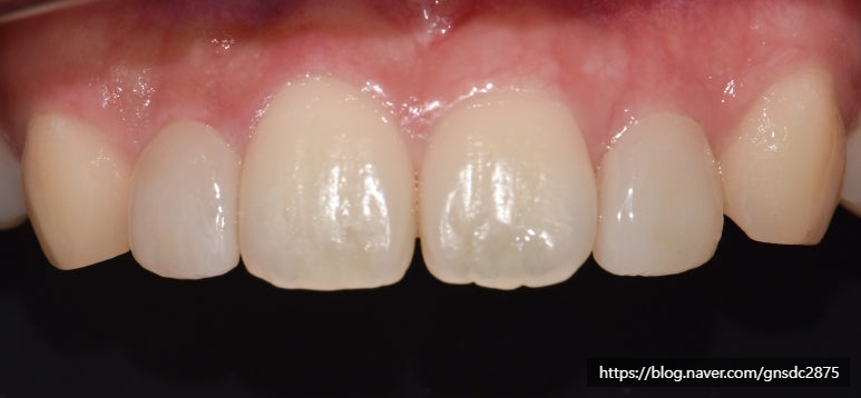 치아가 작아서 콤플렉스? 왜소치 개선 전후 사례👐 / 강남레옹치과 관련 이미지 7