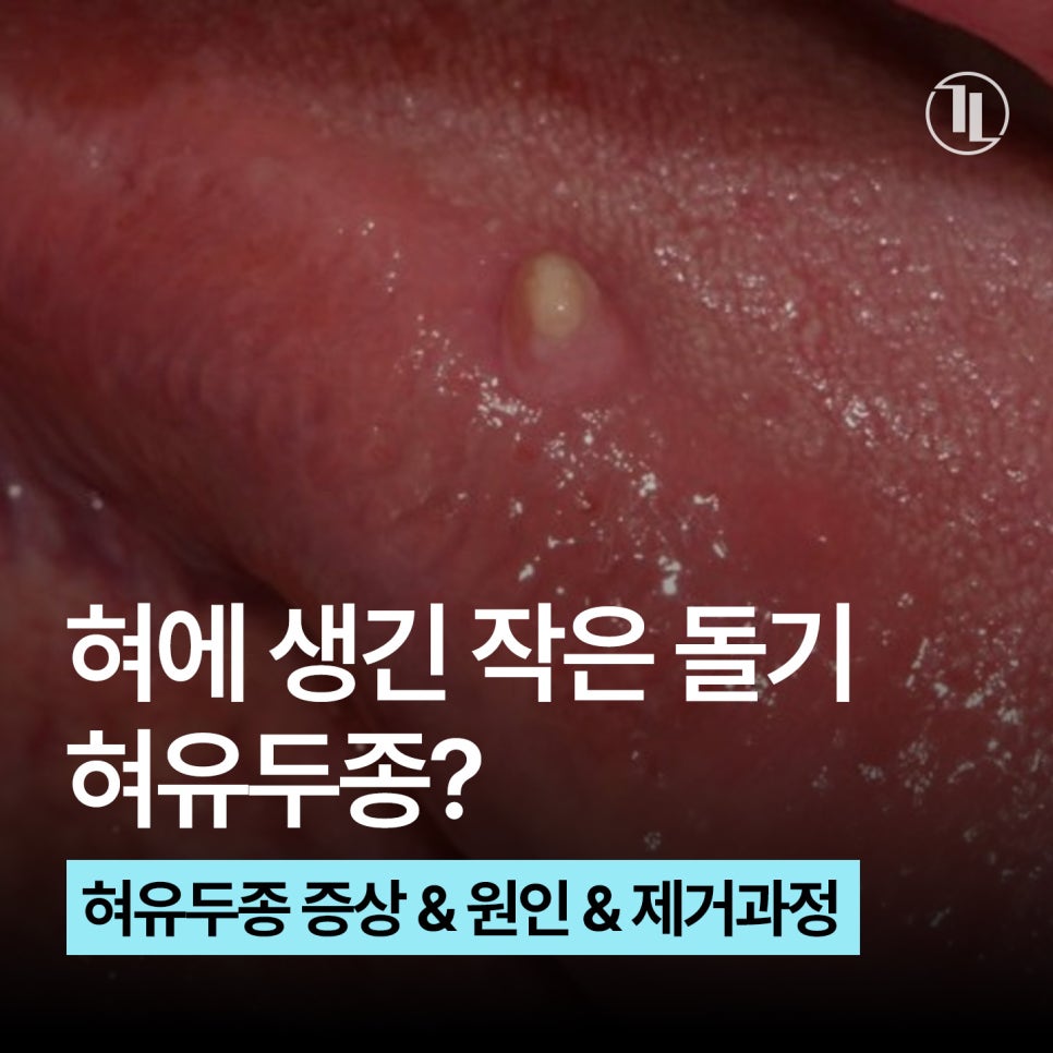 Small Bump (Growth) on the Tongue: Symptoms and Causes of Tongue Papilloma, and the Removal Process / Gangnam Leon Dental Clinic image 1