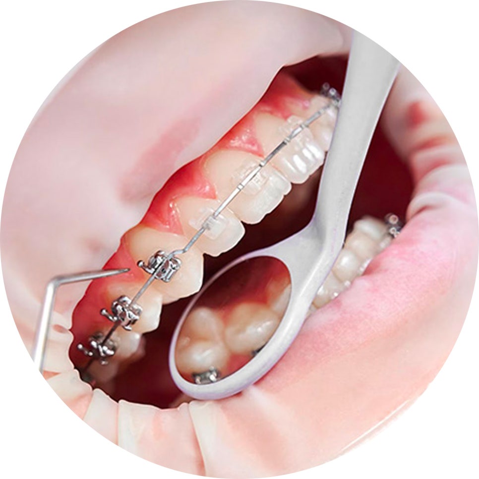 치아교정 종류와 선택법 & 관리 꿀팁 5가지!🖐️ / 강남레옹치과 관련 이미지 2