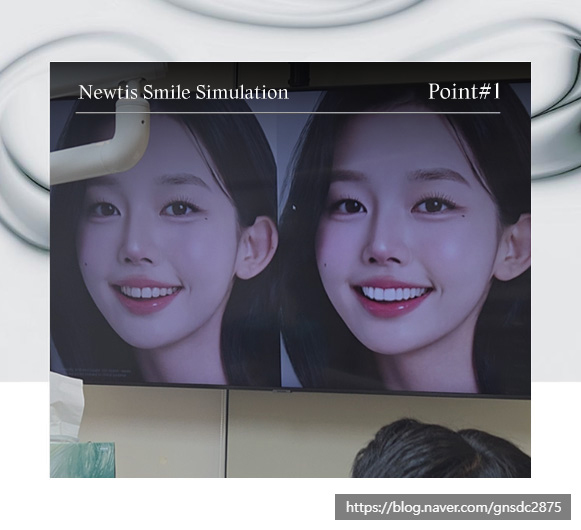 앞니 벌어짐, 정중이개 뉴티스라미 / 강남레옹치과 뉴티스 스마일 시뮬레이션 관련 이미지 4