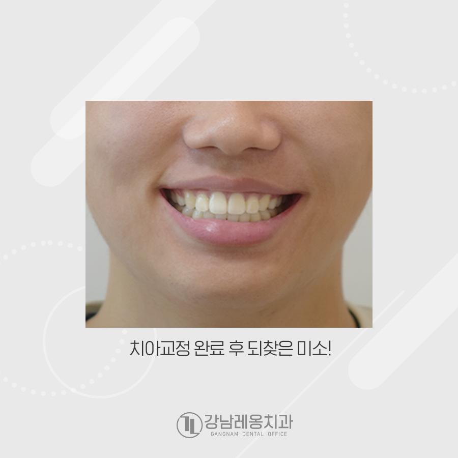 돌출입, 치아교정으로 심미라인에 맞춰 예쁘게 완성 관련 이미지 4
