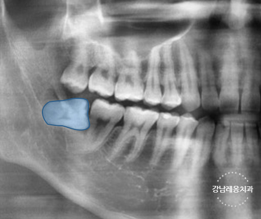 사랑니 발치, 왜 어떤 경우에 대학병원을 권유할까? / 강남레옹치과 관련 이미지 4