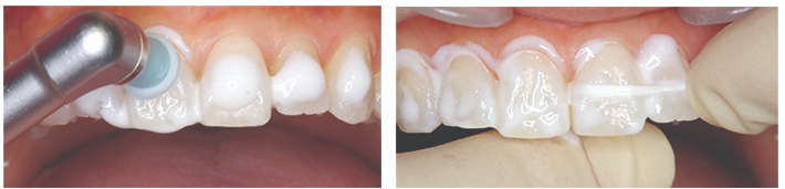 치아성분 치아영양제 아파프로로 약해진 치아관리! / 강남레옹치과 관련 이미지 8