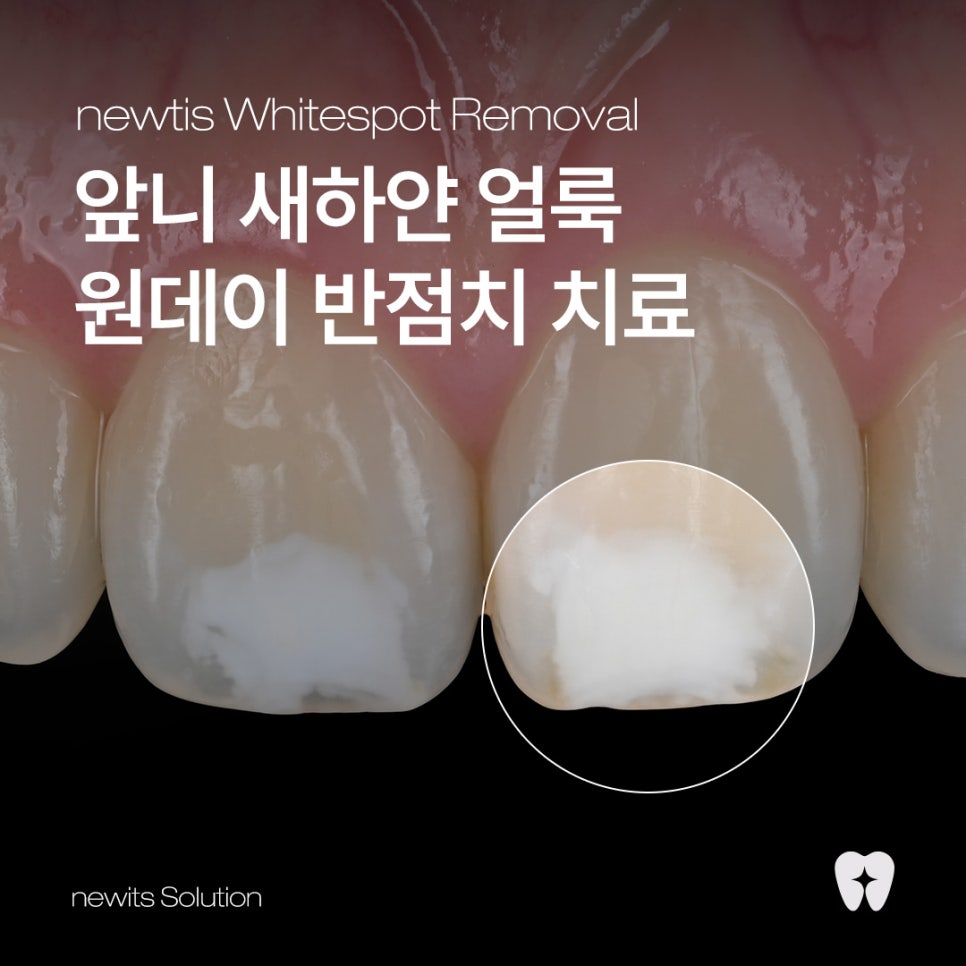 앞니 하얀얼룩, 하루만에 제거! 뉴티스 반점치 치료 / 강남레옹치과 관련 이미지 1