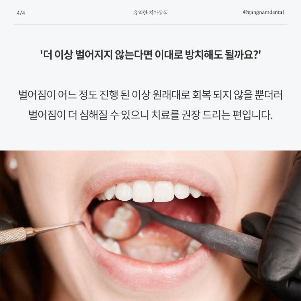 치아 벌어짐 / 앞니 사이 간격 넓어짐 / 정중이개 원인의 증상 그리고 개선할 수 있는 방법에 대해 관련 이미지 5