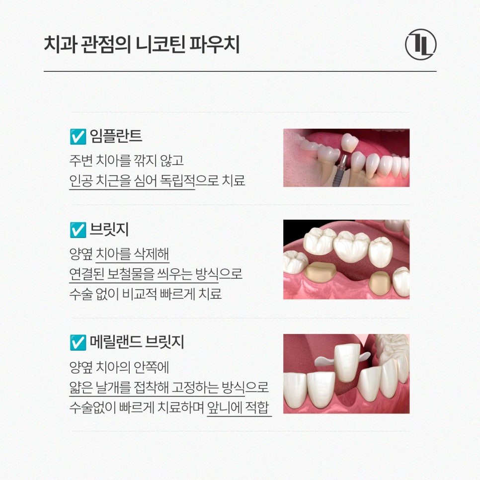 Lost a Front Tooth? Comparing Maryland Bridges, Traditional Bridges, and Implants / Gangnam Leon Dental Clinic image 4